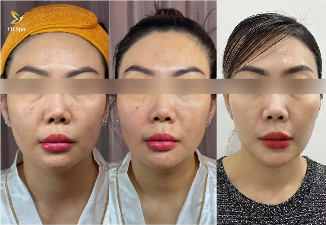 LINEARZ - SIÊU CÔNG NGHỆ NÂNG CƠ ĐỘT PHÁ, CHÍNH THỨC CÓ MẶT TẠI VIỆN THẨM MỸ YB SPA 22 LINEARZ – SIÊU CÔNG NGHỆ NÂNG CƠ ĐỘT PHÁ, CHÍNH THỨC CÓ MẶT TẠI VIỆN THẨM MỸ YB SPA