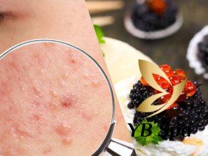 Ăn trứng cá có nổi mụn không? Cách ăn trứng cá không bị mụn