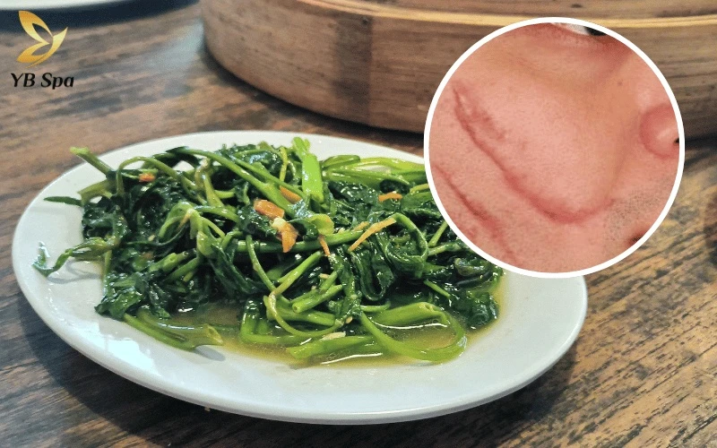 Hoạt chất Madecassol trong rau muống có thể khiến bề mặt da gồ ghề, vì vậy bạn cần tuyệt đối tránh món ăn này cho đến khi da ổn định