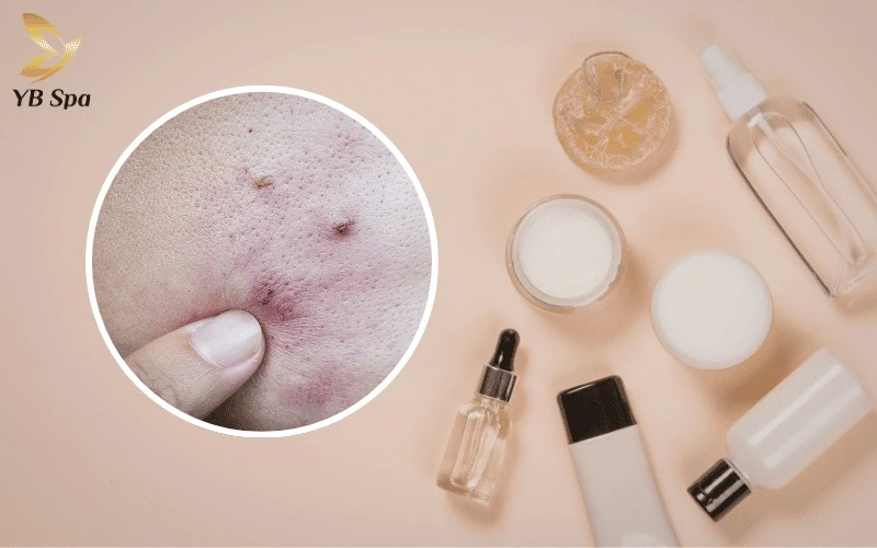 Tạm ngưng các hoạt chất mạnh như AHA, BHA hay Retinol trong 10 ngày đầu để bảo vệ da khỏi nguy cơ bỏng rát và kích ứng