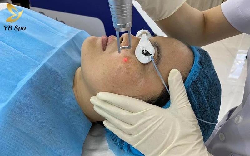 Bắn tia laser trị nám có tốt không