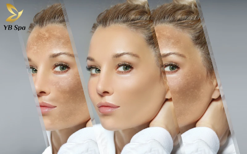 Thời gian điều trị ngắn – không cần nghỉ dưỡng