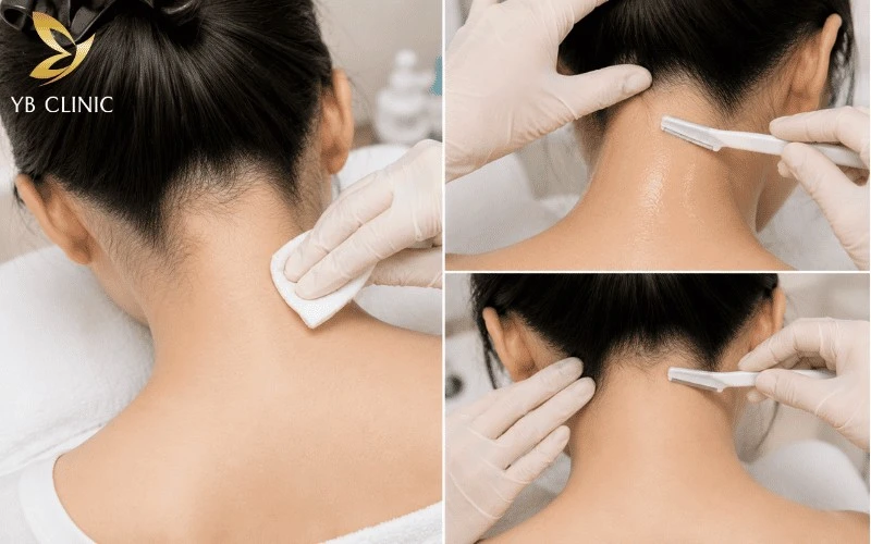 Bảng Giá Triệt Lông Gáy Vĩnh Viễn Mới Nhất 2026 11 Làm sạch và cạo đúng kỹ thuật vùng gáy trước khi triệt giúp loại bỏ tạp chất, bảo vệ da và giữ lại gốc nang lông để hấp thụ năng lượng ánh sáng hiệu quả.