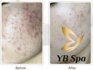 Sau khoảng một tuần sử dụng BHA, bạn có thể nhận thấy quá trình mụn giảm dần.