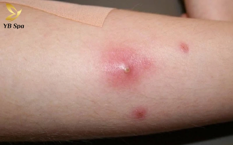 Bị mụn nhọt có ăn được thịt gà không? Thực phẩm nên và không nên ăn