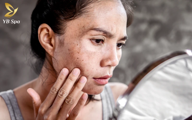 Bị nám da mặt phải làm sao? Chia sẻ giải pháp trị nám tận gốc, an toàn 24 Nám da mặt