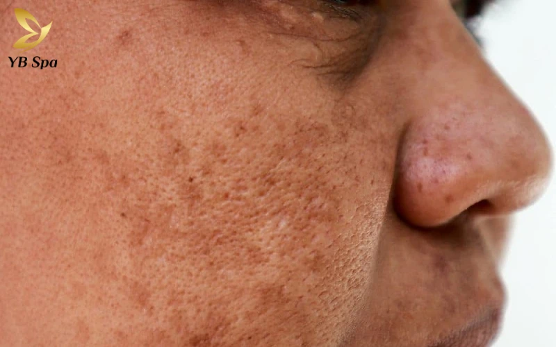 Bị nám da mặt phải làm sao? Chia sẻ giải pháp trị nám tận gốc, an toàn 25 bị nám da mặt phải làm sao