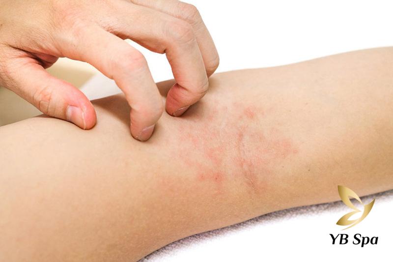 Bị Ngứa Sau Khi Triệt Lông Vĩnh Viễn: Cách Xử Lý Hiệu Quả 22 Tẩy lông xong bị ngứa nên dùng kem dưỡng ẩm có thành phần thiên nhiên để tránh kích ứng (Nguồn: Internet)