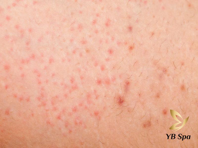 Bị Ngứa Sau Khi Triệt Lông Vĩnh Viễn: Cách Xử Lý Hiệu Quả 24 Quy trình triệt lông không đảm bảo làm tăng nguy cơ viêm nang lông (Nguồn: Internet)