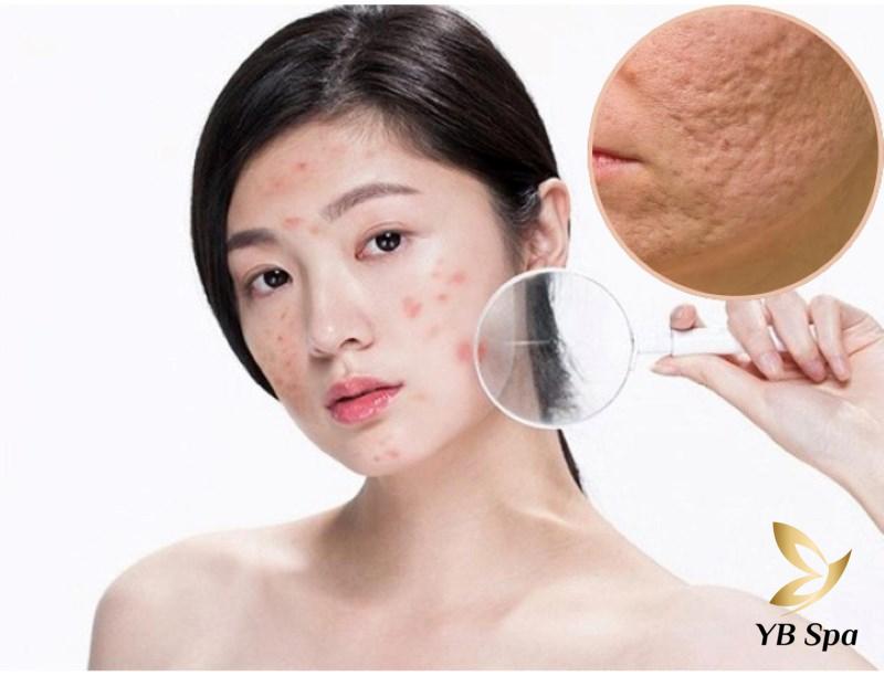 Da bị nổi mụn do đâu? Các cách điều trị mụn chuẩn y khoa 30 Biến chứng mặt bị rổ do bị mụn