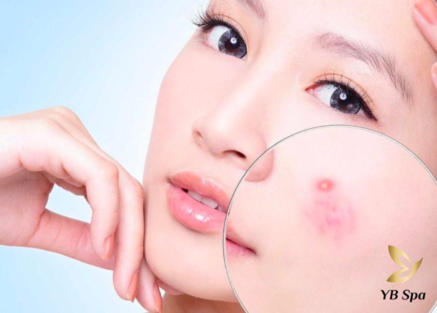 Da bị nổi mụn do đâu? Các cách điều trị mụn chuẩn y khoa 23 Nổi mụn ở má