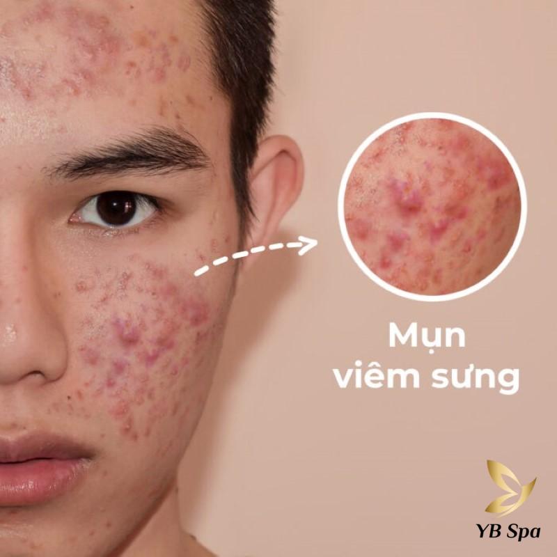 Da bị nổi mụn do đâu? Các cách điều trị mụn chuẩn y khoa 24 Mụn bị viêm sưng
