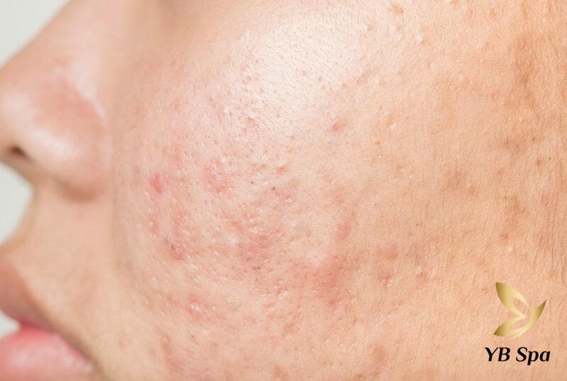 Da bị nổi mụn do đâu? Các cách điều trị mụn chuẩn y khoa 25 Mụn không viêm