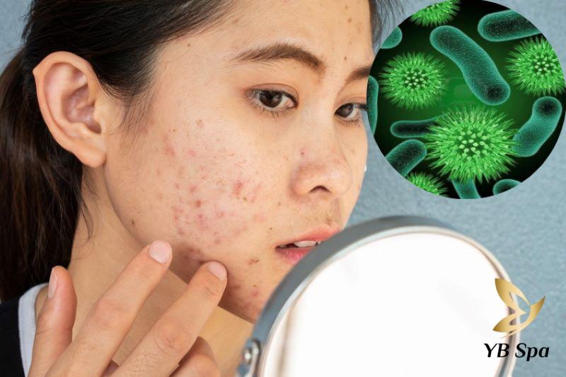 Da bị nổi mụn do đâu? Các cách điều trị mụn chuẩn y khoa 26 Mụn do da bị nhiễm trùng