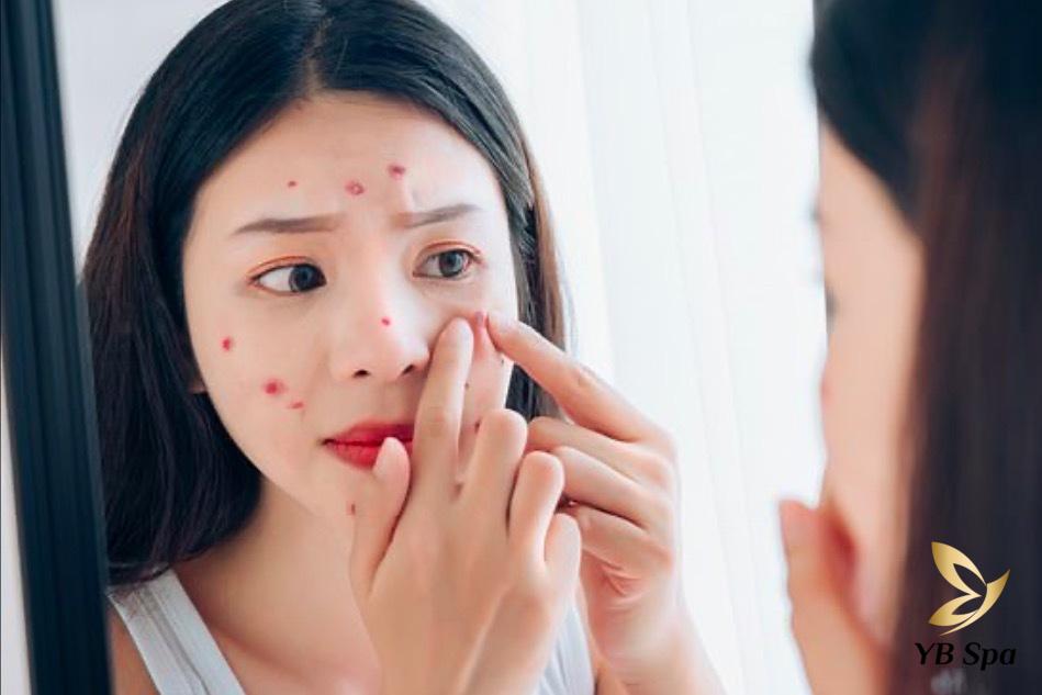 Da bị nổi mụn do đâu? Các cách điều trị mụn chuẩn y khoa 29 Dùng tay nặn mụn