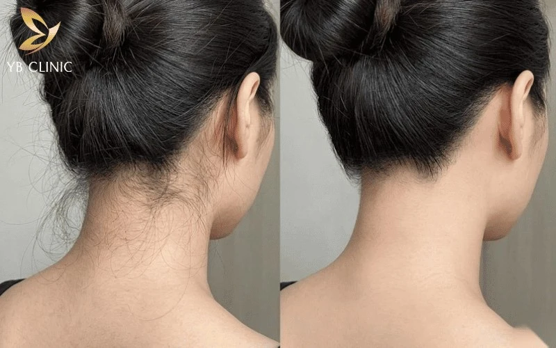 Bí Quyết Để Mặc Váy Hở Lưng Đẹp Hơn Với Vùng Cổ Gáy Gọn Gàng 9 Đường chân tóc gáy gọn gàng giúp vùng cổ sáng hơn, tạo cảm giác cổ cao và tổng thể phía sau thanh thoát hơn.
