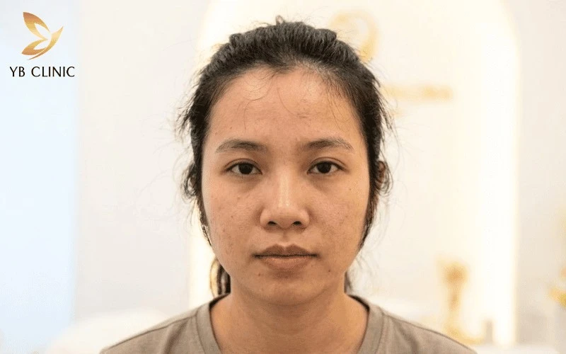 Bí Quyết Giúp Gương Mặt Thanh Thoát Mà Không Cần Phẫu Thuật 8 Đường chân tóc thấp và nhiều tóc tơ khiến vầng trán trông ngắn, gương mặt kém thanh thoát.