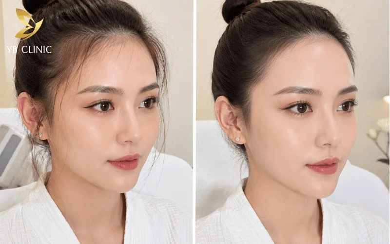 Bí Quyết Giúp Gương Mặt Thanh Thoát Mà Không Cần Phẫu Thuật 9 Triệt gọn tóc tơ và tóc mai giúp vầng trán sáng hơn, gương mặt thanh thoát hơn và các đường nét trở nên hài hòa, nổi bật tự nhiên.