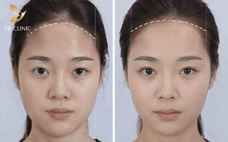 Bí Quyết Sở Hữu Gương Mặt Phúc Hậu Tròn Đầy Nhờ Triệt Đường Chân Tóc 10 Trán hẹp do cấu trúc xương đầu cần cân nhắc kỹ khi triệt đường chân tóc để tránh làm mất cân đối và thiếu tự nhiên cho gương mặt.