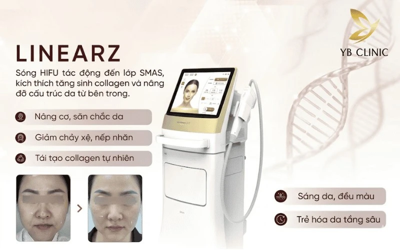 Bí Quyết Trẻ Lâu Nhờ Thói Quen Khoa Học Và Thẩm Mỹ 12 Nâng cơ trẻ hóa với công nghệ LinearZ giúp xóa nhăn, thon gọn gương mặt an toàn