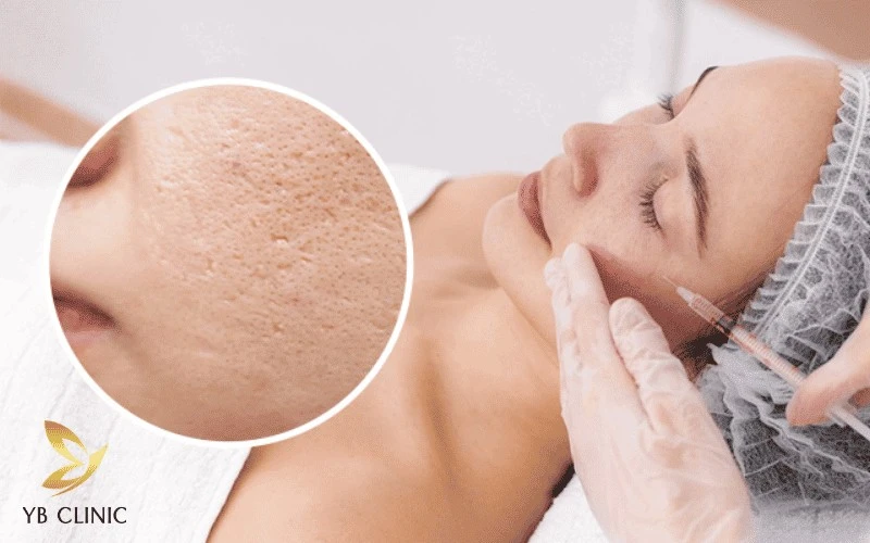 Bí Quyết Trẻ Lâu Nhờ Thói Quen Khoa Học Và Thẩm Mỹ 14 Liệu pháp tiêm meso đưa dưỡng chất trực tiếp vào trung bì để nuôi dưỡng tế bào da.