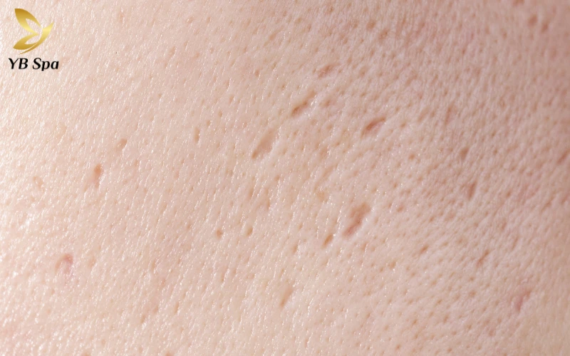 Bị sẹo lõm có nên ăn rau muống không? 26 Tổng quan về sẹo lõm