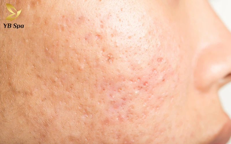 Bị sẹo lõm có nên ăn rau muống không? 27 Cơ chế khoa học của việc hình thành sẹo lõm