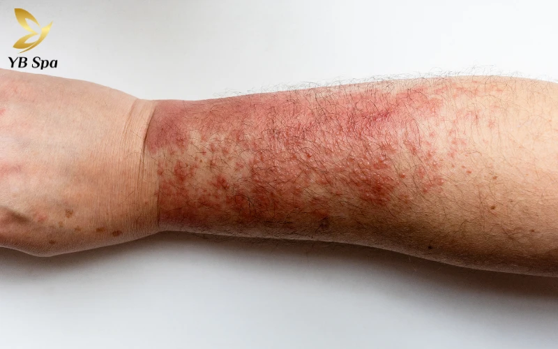 Bị viêm da tiếp xúc có để lại sẹo không? 21 Viêm da tiếp xúc là gì?