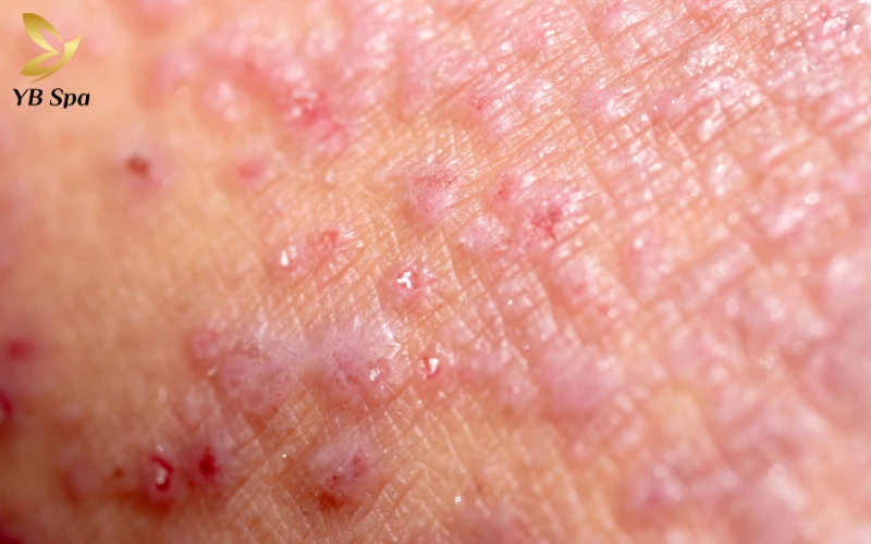 Bị viêm da tiếp xúc có để lại sẹo không? 23 Bị viêm da tiếp xúc có để lại sẹo không?