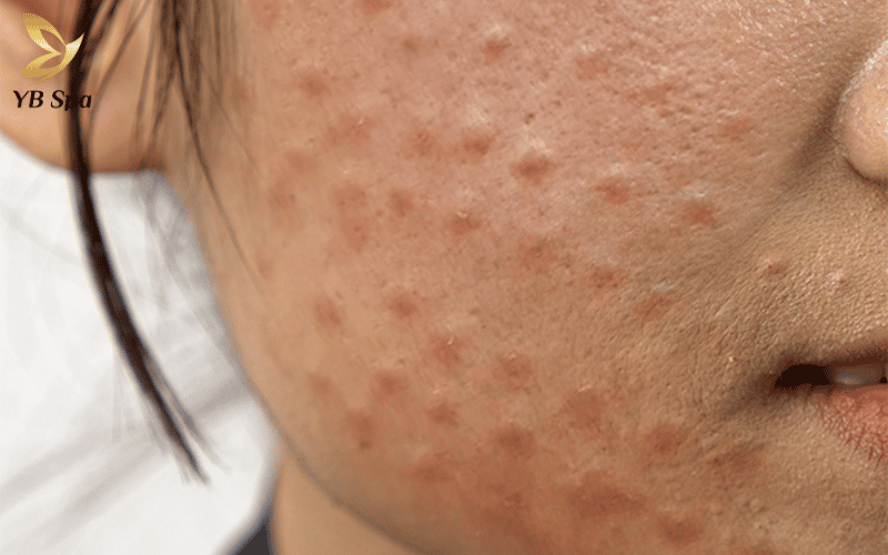 Biến chứng khi tiêm meso là gì? Dấu hiệu nhận biết và cách xử lý kịp thời 27 Khác với sưng nề sinh lý, u hạt thường bùng phát muộn và cần sự can thiệp y khoa chuyên sâu để xử lý triệt để các khối u nhỏ