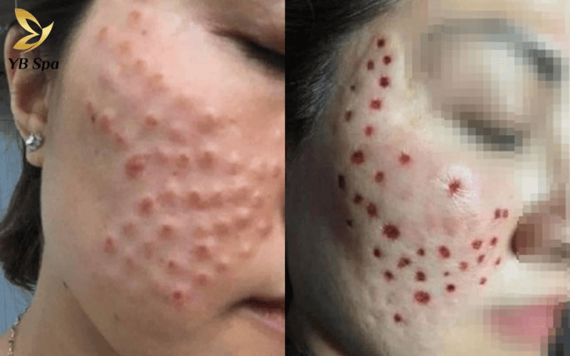 Biến chứng khi tiêm meso là gì? Dấu hiệu nhận biết và cách xử lý kịp thời 29 Việc chậm trễ trong xử lý tắc mạch sẽ dẫn đến hoại tử, rụng mô và để lại những vết sẹo lõm vĩnh viễn gây mất thẩm mỹ nghiêm trọng