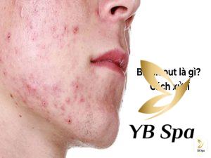 Break out là gì? Da bị break out mụn là gì? Cách xử lí