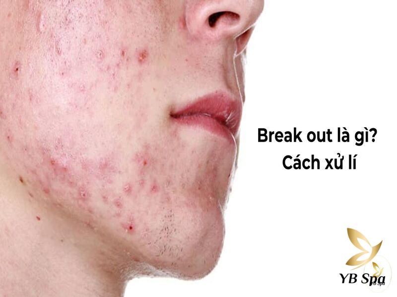 Break Out Là Gì? Da Bị Break Out Mụn Là Gì? Cách Xử Lí