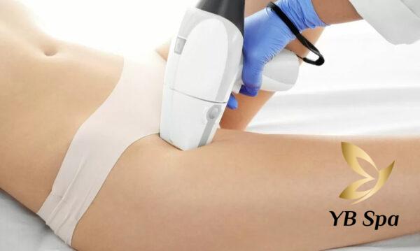 Các Kiểu Triệt Lông Bikini Phổ Biến Hiện Nay 15 Triệt lông bikini bằng laser (Nguồn: Internet)