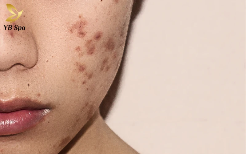 Phân biệt các loại mụn thường gặp