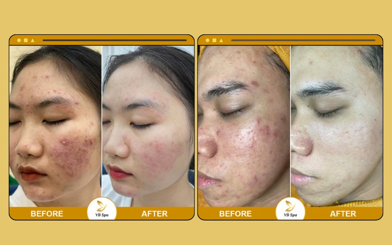 YB Spa điều trị mụn