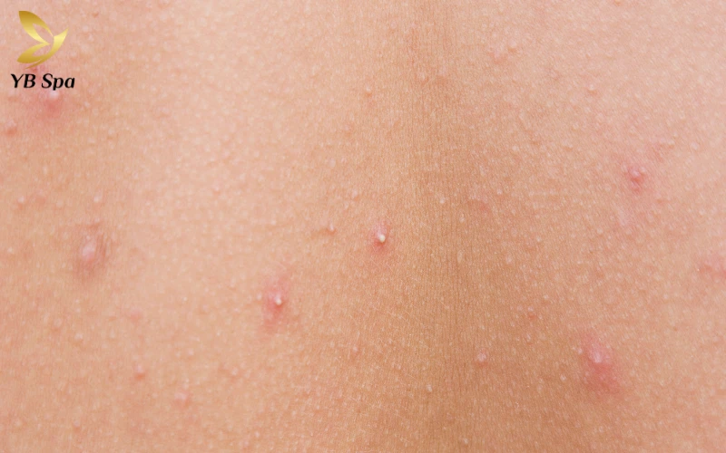 Mụn đầu trắng