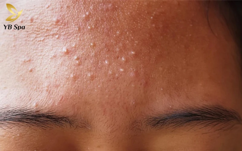 Mụn ẩn dưới da