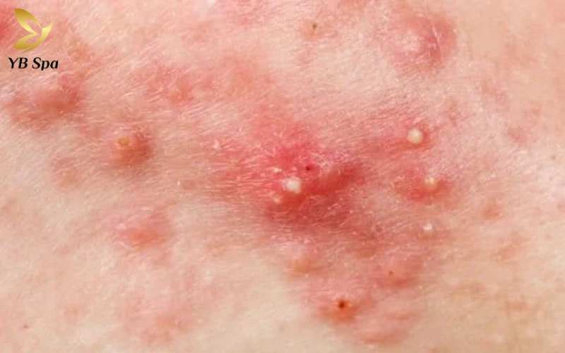 Mụn viêm (mụn đỏ, mụn mủ)