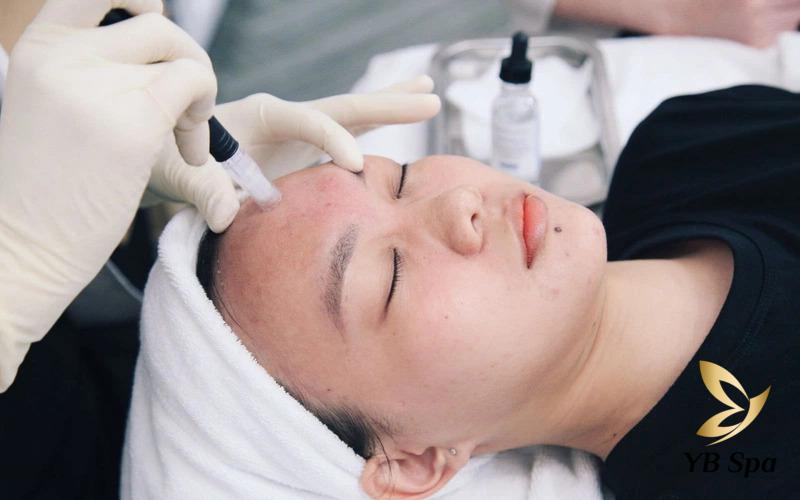 Các phương pháp tiêm meso hiệu quả nhất 2025 15 Tiêm meso trị mụn