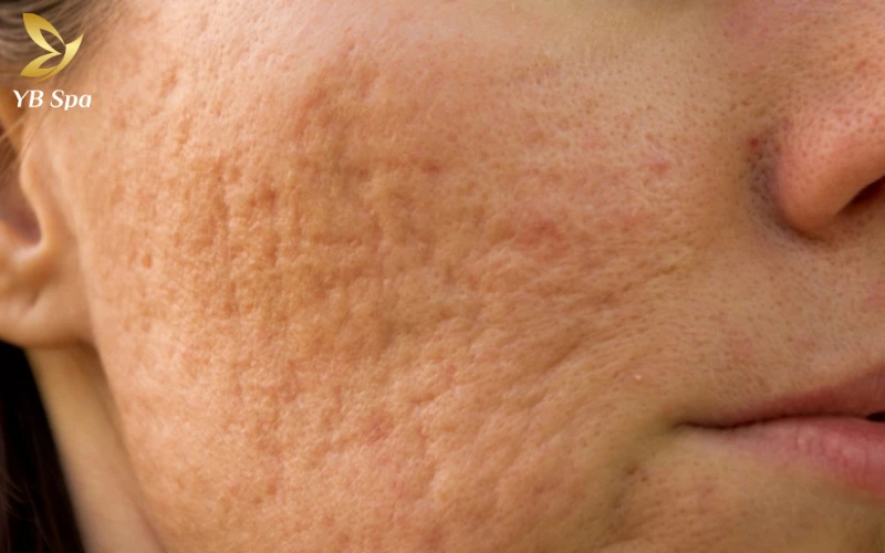 Cách chăm sóc da bị sẹo lõm an toàn, hiệu quả từ A - Z 23 da bị sẹo lõm