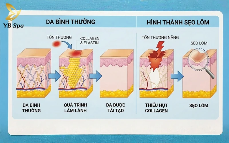 Cách chăm sóc da bị sẹo lõm an toàn, hiệu quả từ A - Z 24 Cơ chế hình thành sẹo lõm