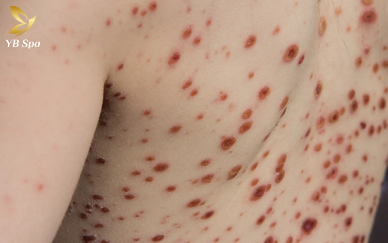 Cách chăm sóc da bị sẹo lõm an toàn, hiệu quả từ A - Z 26 Bệnh thủy đậu (Trái rạ)