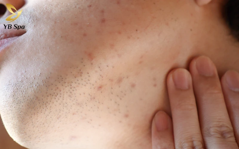 Vết thâm và sẹo