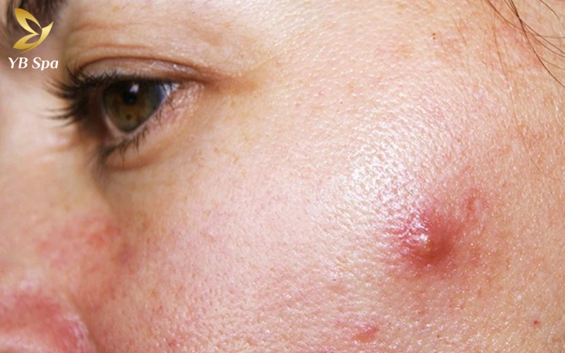 Cách Chữa Mụn Nhọt Sưng To An Toàn, Hiệu Quả