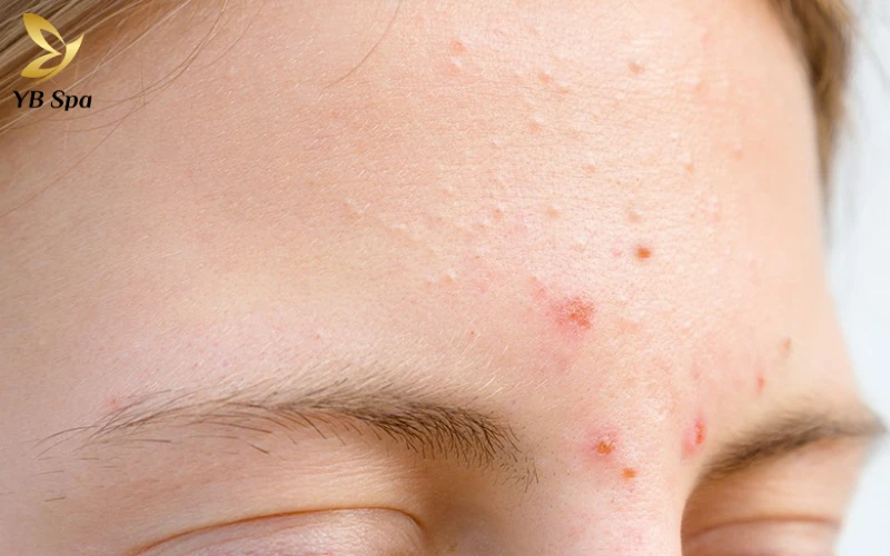 Cách để hết mụn trên trán hiệu quả và khoa học