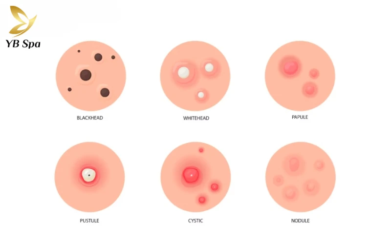 Cách để hết mụn trên trán hiệu quả và khoa học 23 Nguyên nhân gây ra mụn trên trán
