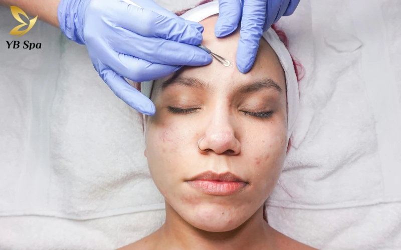 Cách để hết mụn trên trán hiệu quả và khoa học 27 Lấy nhân mụn chuẩn y khoa