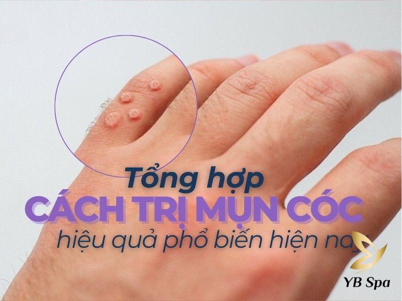 cách điều trị mụn cóc