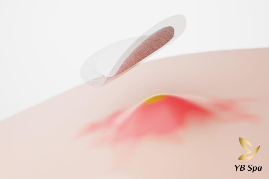 Mụn sưng hình thành do đâu? 9 Cách giảm sưng mụn hiệu quả 19 Nguyên nhân hình thành mụn sưng là do những nang lông bị bít tắc